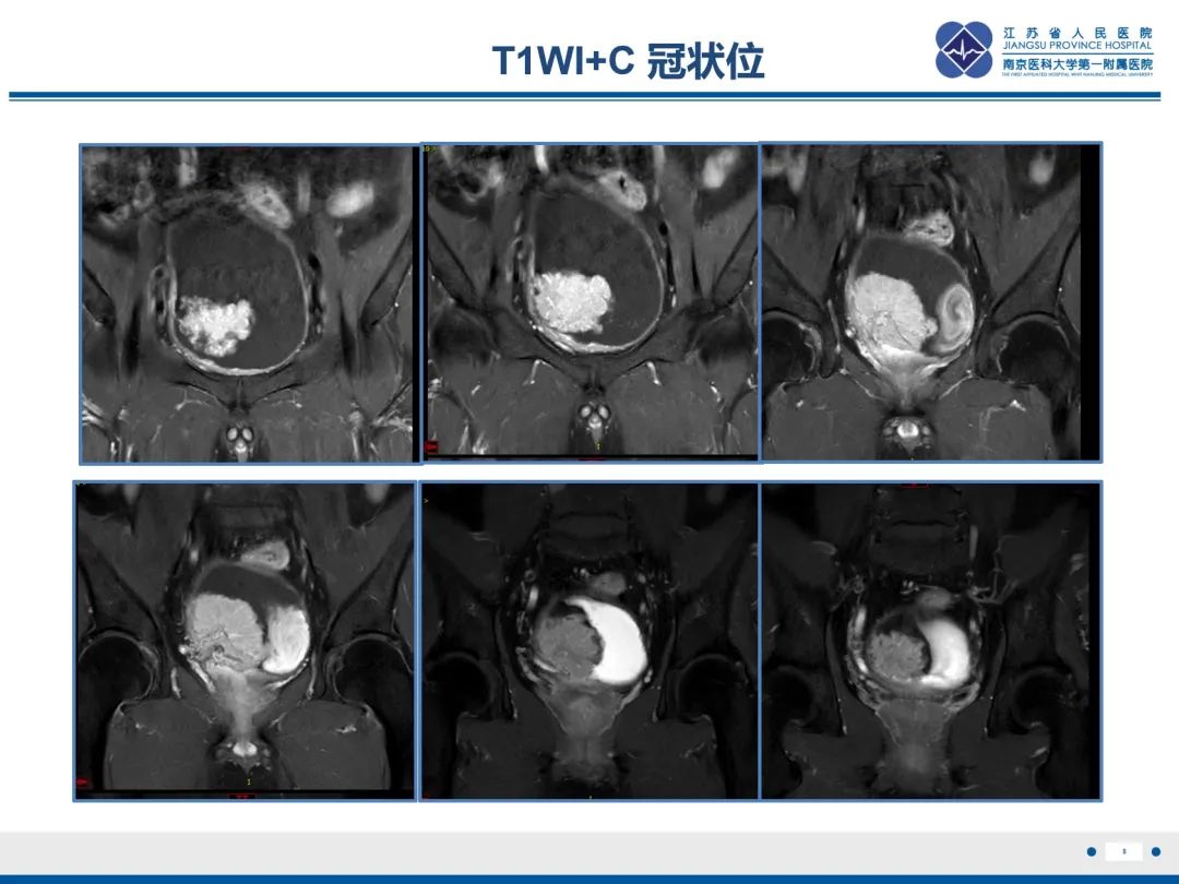 影像PPT - 【PPT】膀胱癌-9
