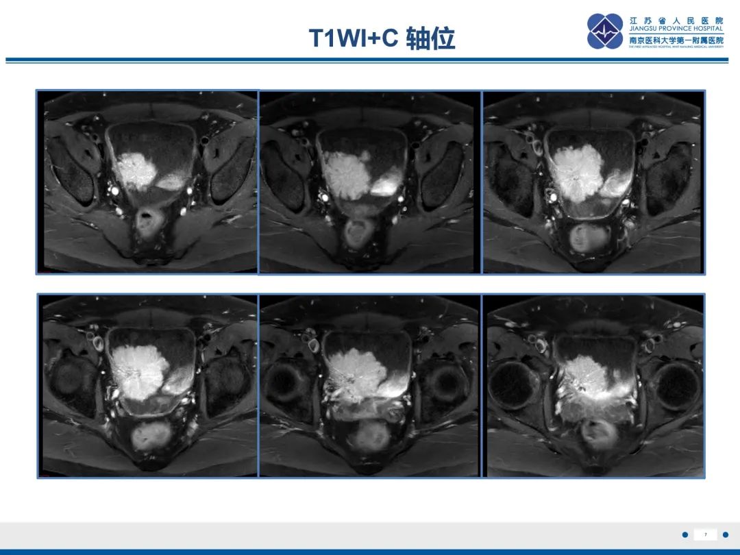 影像PPT - 【PPT】膀胱癌-8