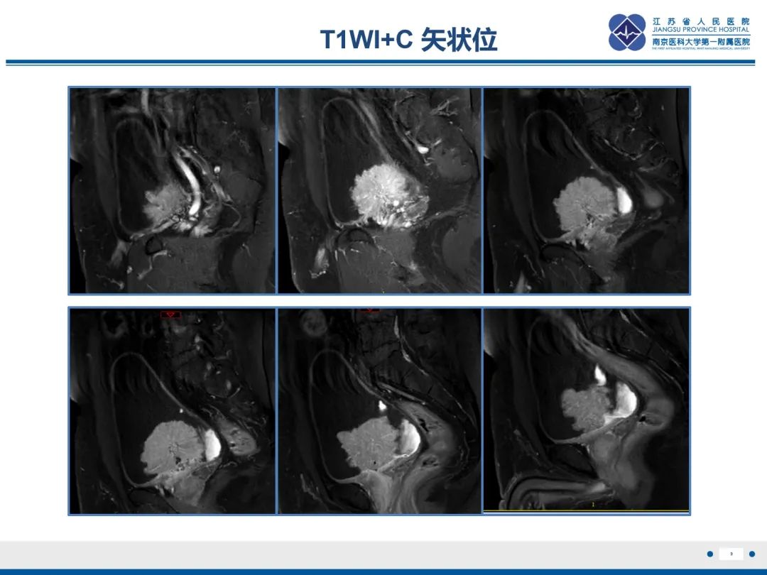 影像PPT - 【PPT】膀胱癌-10