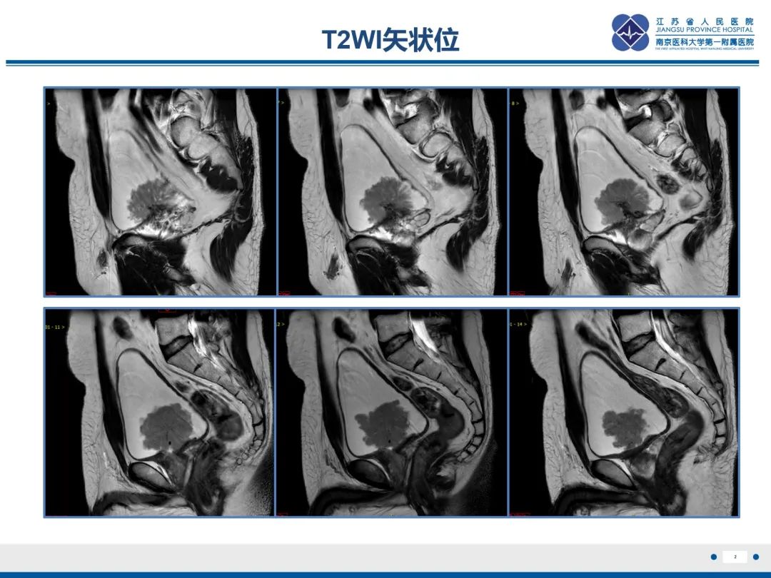 影像PPT - 【PPT】膀胱癌-3