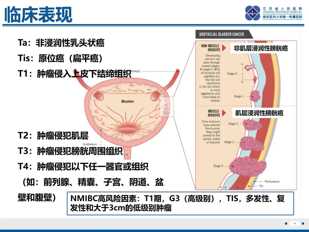 影像PPT - 【PPT】膀胱癌-26