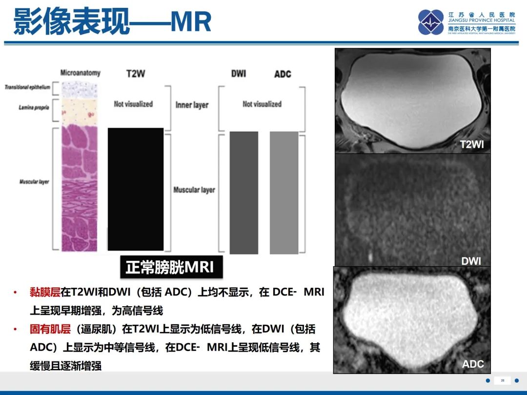 影像PPT - 【PPT】膀胱癌-29