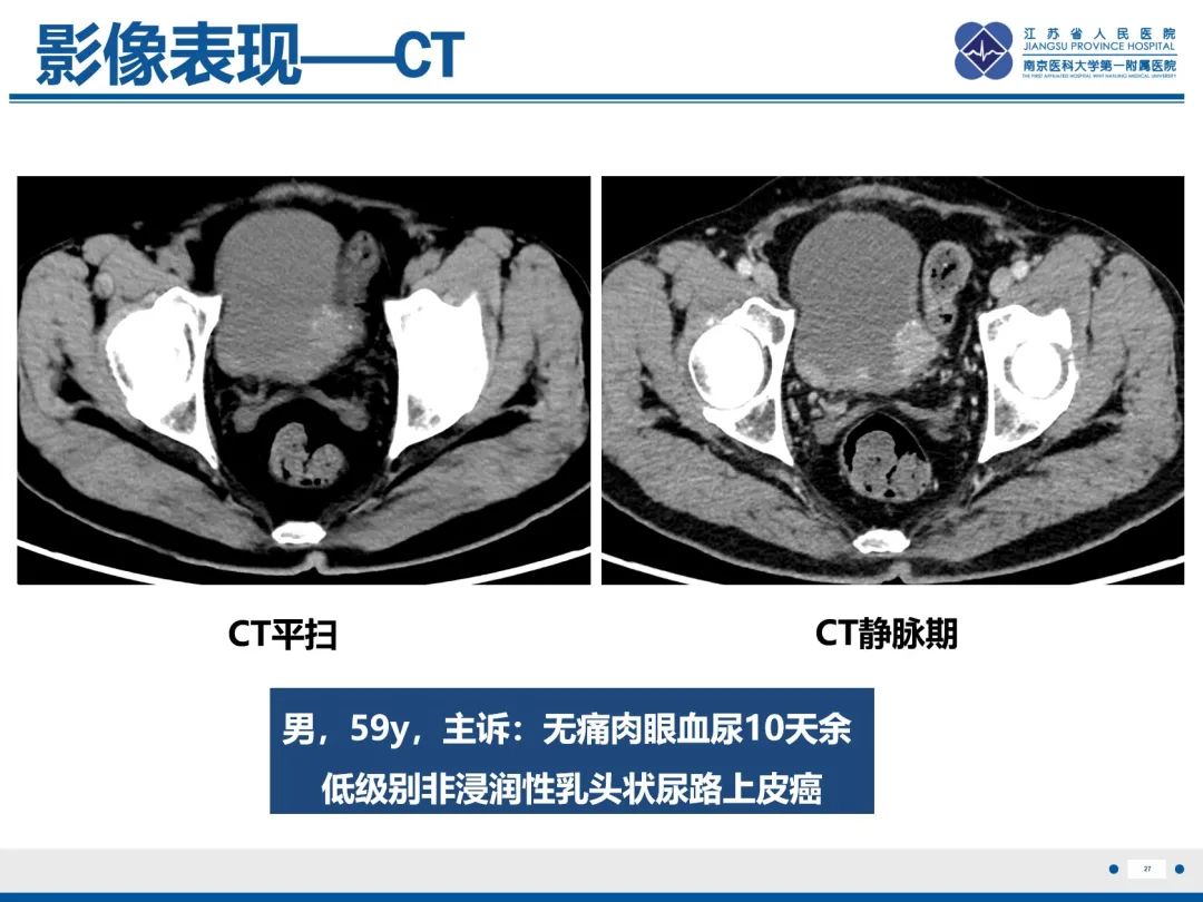 影像PPT - 【PPT】膀胱癌-28