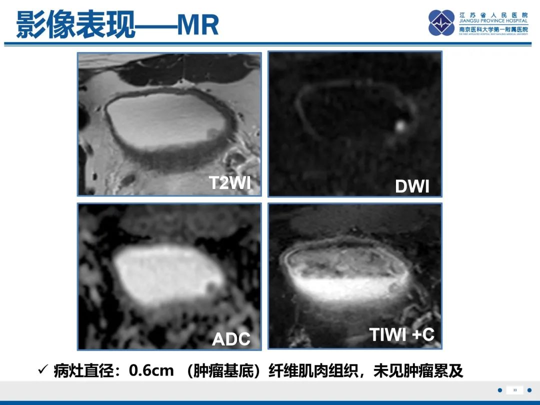 影像PPT - 【PPT】膀胱癌-34
