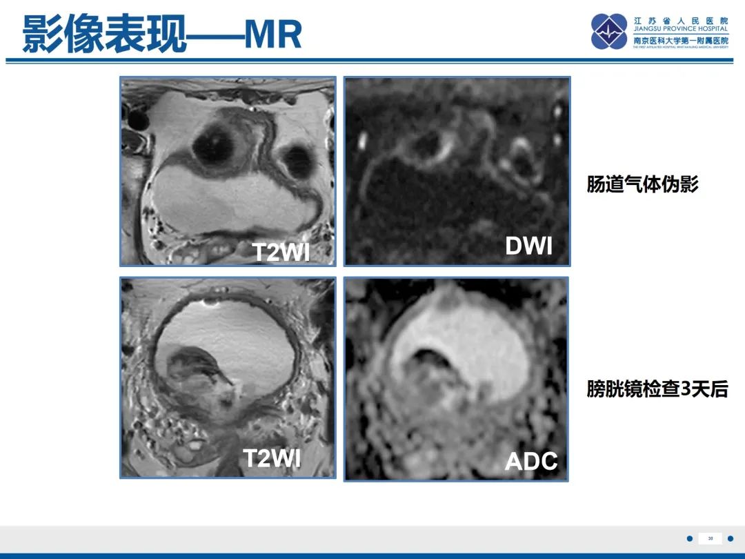 影像PPT - 【PPT】膀胱癌-31