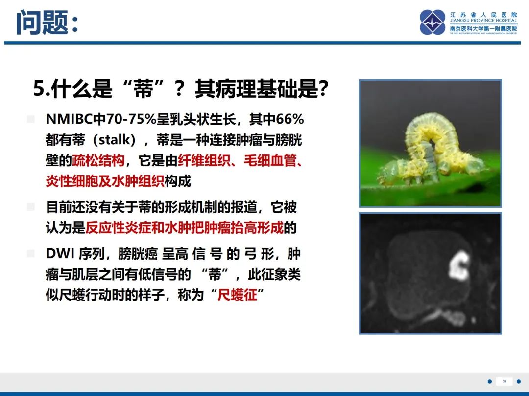影像PPT - 【PPT】膀胱癌-36