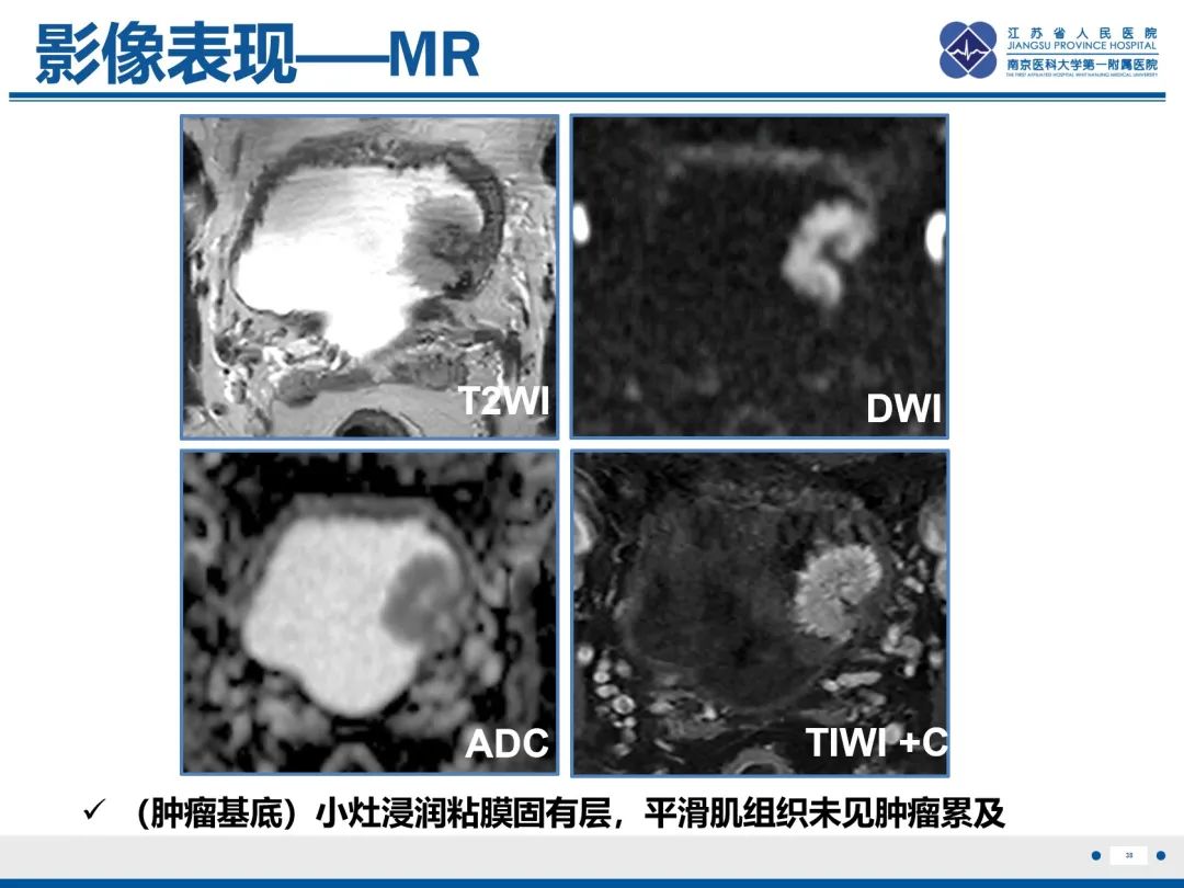 影像PPT - 【PPT】膀胱癌-39