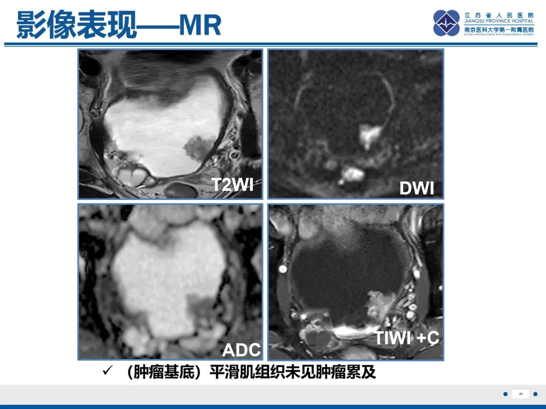 影像PPT - 【PPT】膀胱癌-41