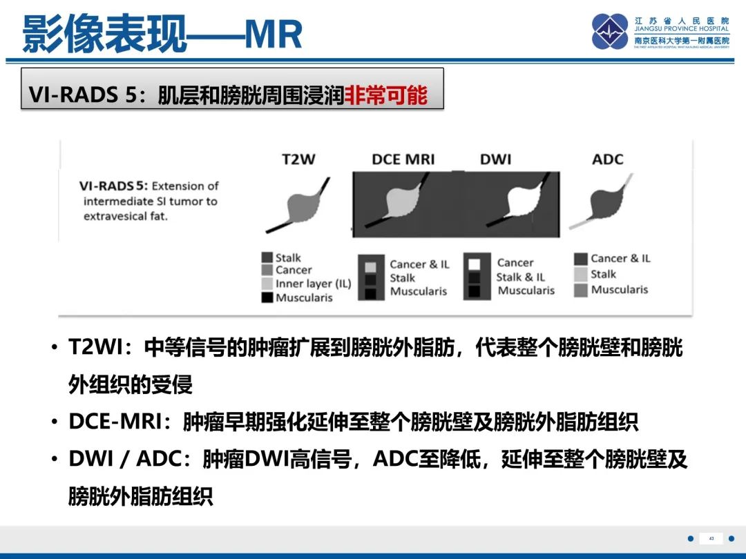 影像PPT - 【PPT】膀胱癌-44