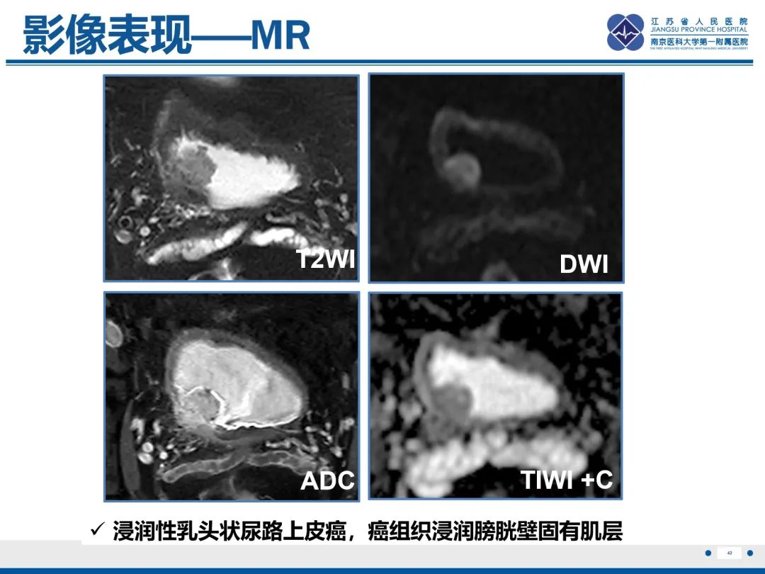 影像PPT - 【PPT】膀胱癌-43