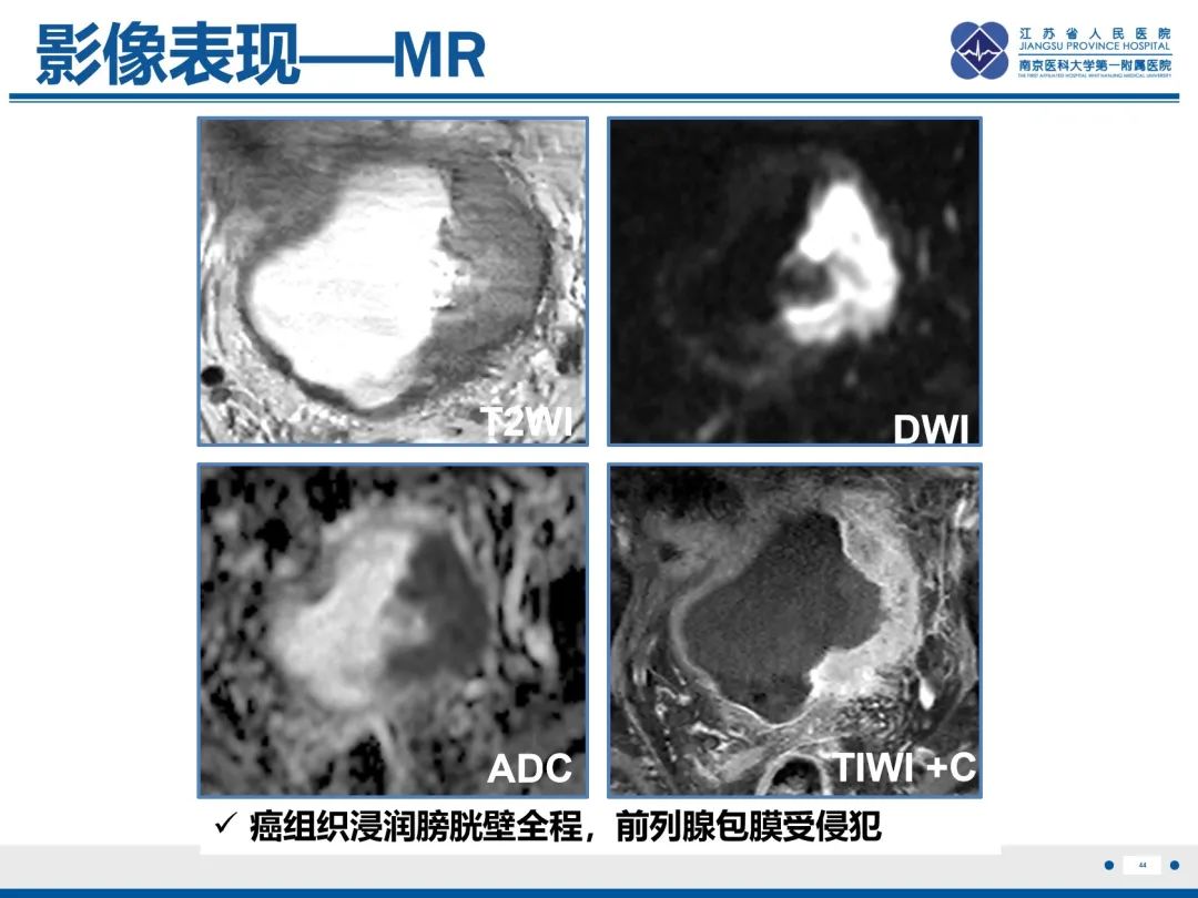 影像PPT - 【PPT】膀胱癌-45