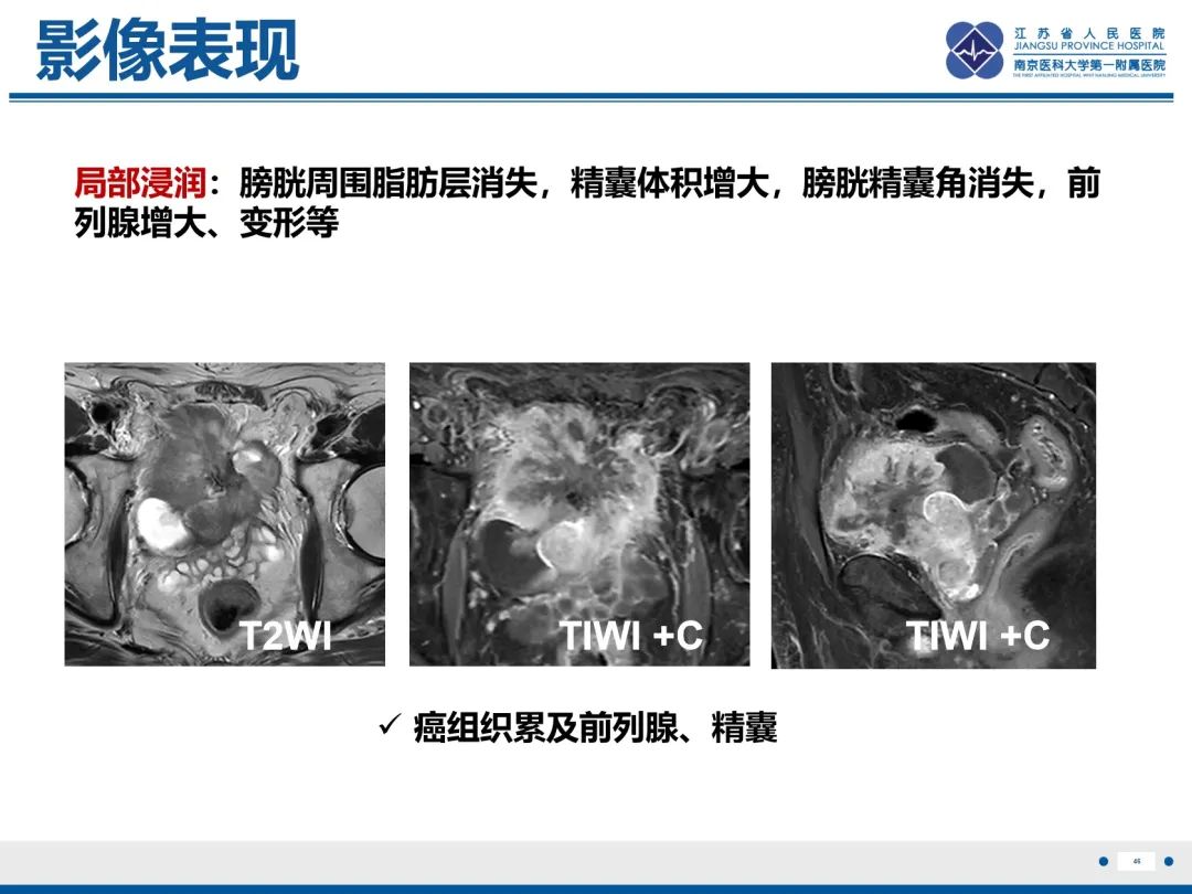 影像PPT - 【PPT】膀胱癌-47