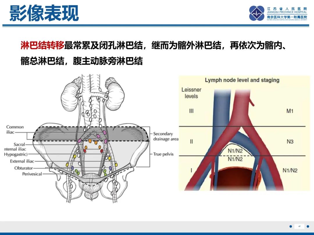 影像PPT - 【PPT】膀胱癌-48