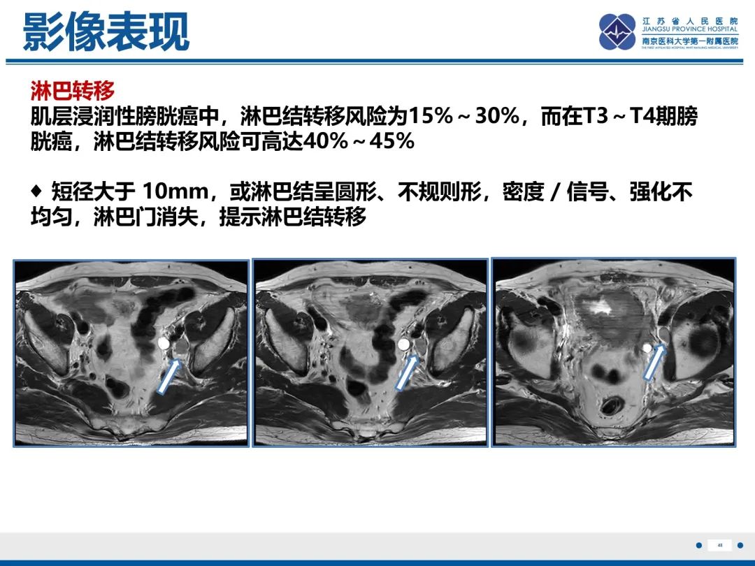影像PPT - 【PPT】膀胱癌-49