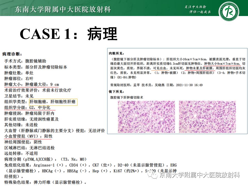 影像PPT - 【PPT】“理”“影”“外”合——肝细胞肝癌-4 影像PPT - 【PPT】“理”“影”“外”合——肝细胞肝癌-4