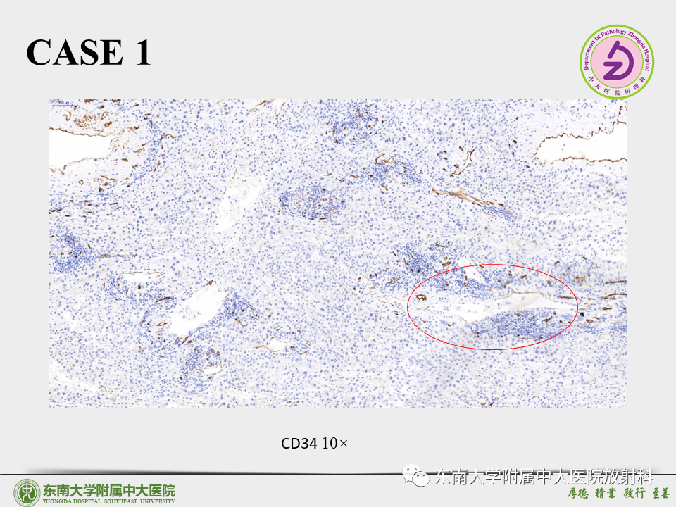 影像PPT - 【PPT】“理”“影”“外”合——肝细胞肝癌-11 影像PPT - 【PPT】“理”“影”“外”合——肝细胞肝癌-11