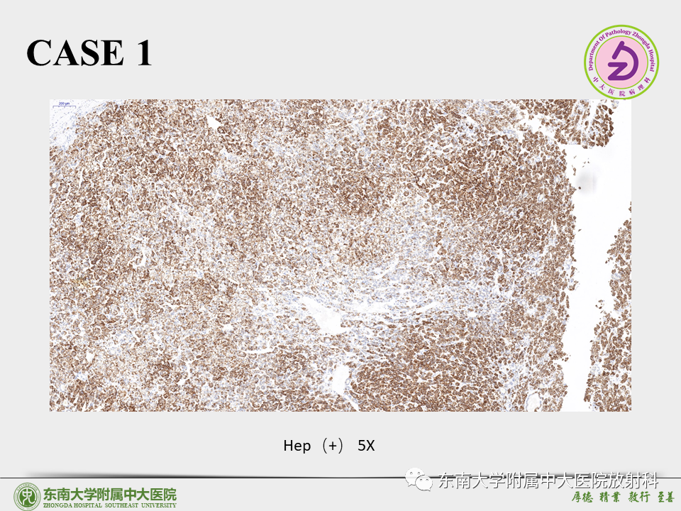 影像PPT - 【PPT】“理”“影”“外”合——肝细胞肝癌-14 影像PPT - 【PPT】“理”“影”“外”合——肝细胞肝癌-14
