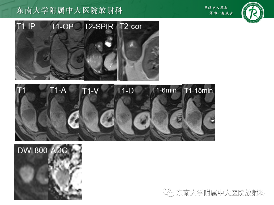 影像PPT - 【PPT】“理”“影”“外”合——肝细胞肝癌-21 影像PPT - 【PPT】“理”“影”“外”合——肝细胞肝癌-21