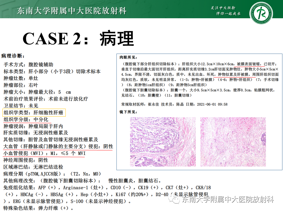 影像PPT - 【PPT】“理”“影”“外”合——肝细胞肝癌-22 影像PPT - 【PPT】“理”“影”“外”合——肝细胞肝癌-22