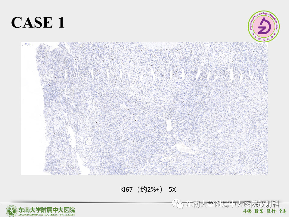影像PPT - 【PPT】“理”“影”“外”合——肝细胞肝癌-16 影像PPT - 【PPT】“理”“影”“外”合——肝细胞肝癌-16