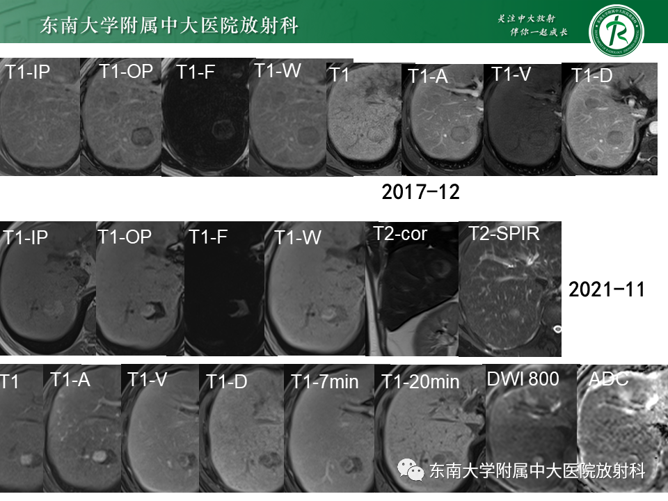 影像PPT - 【PPT】“理”“影”“外”合——肝细胞肝癌-29 影像PPT - 【PPT】“理”“影”“外”合——肝细胞肝癌-29