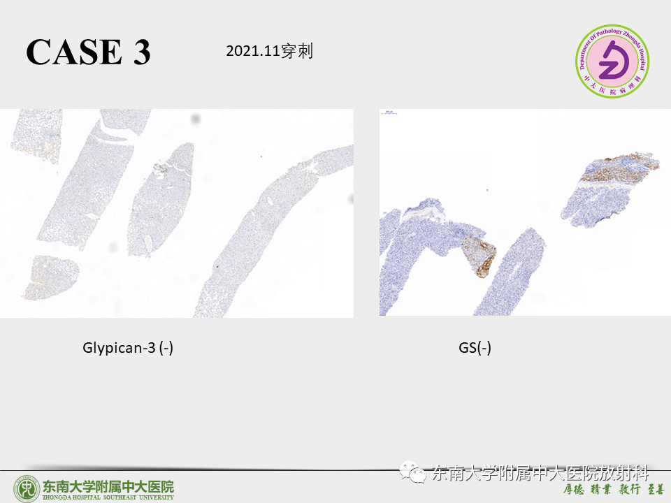 影像PPT - 【PPT】“理”“影”“外”合——肝细胞肝癌-33 影像PPT - 【PPT】“理”“影”“外”合——肝细胞肝癌-33