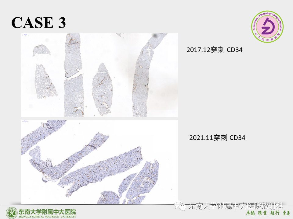 影像PPT - 【PPT】“理”“影”“外”合——肝细胞肝癌-32 影像PPT - 【PPT】“理”“影”“外”合——肝细胞肝癌-32