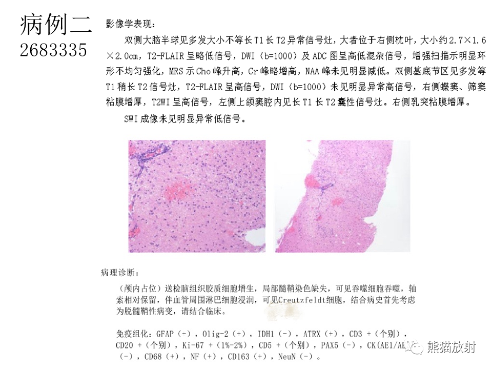 影像PPT - 【病例】脱髓鞘假瘤2例MR影像-31