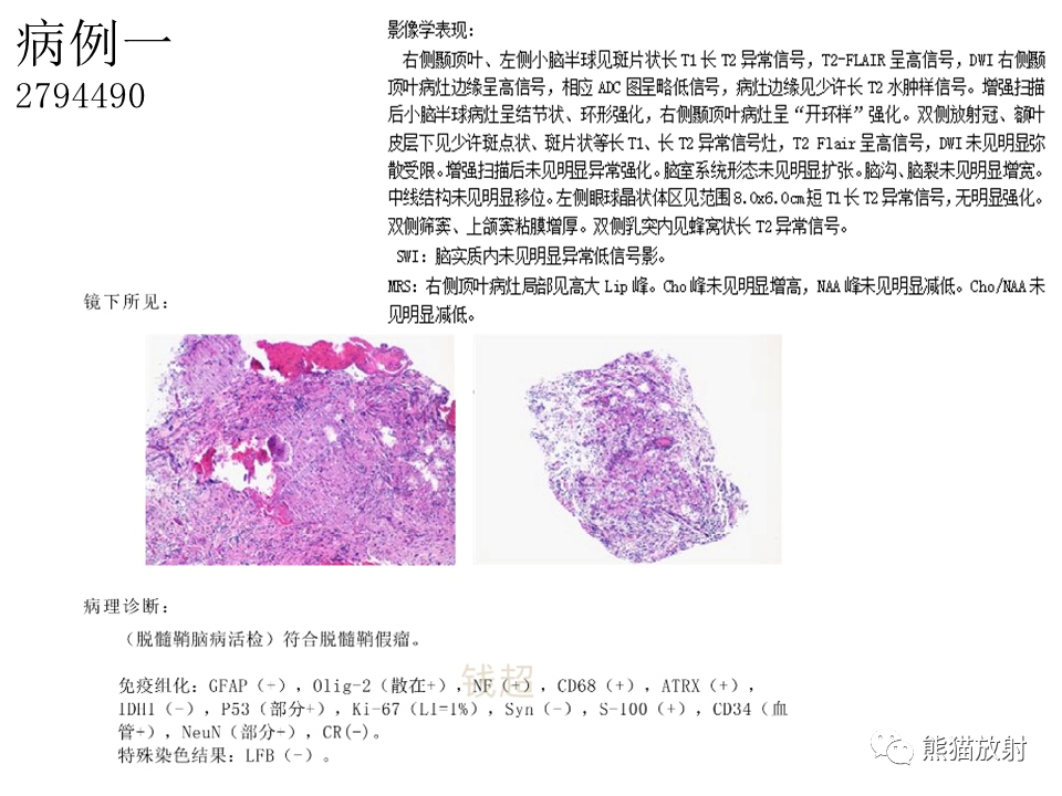 影像PPT - 【病例】脱髓鞘假瘤2例MR影像-30