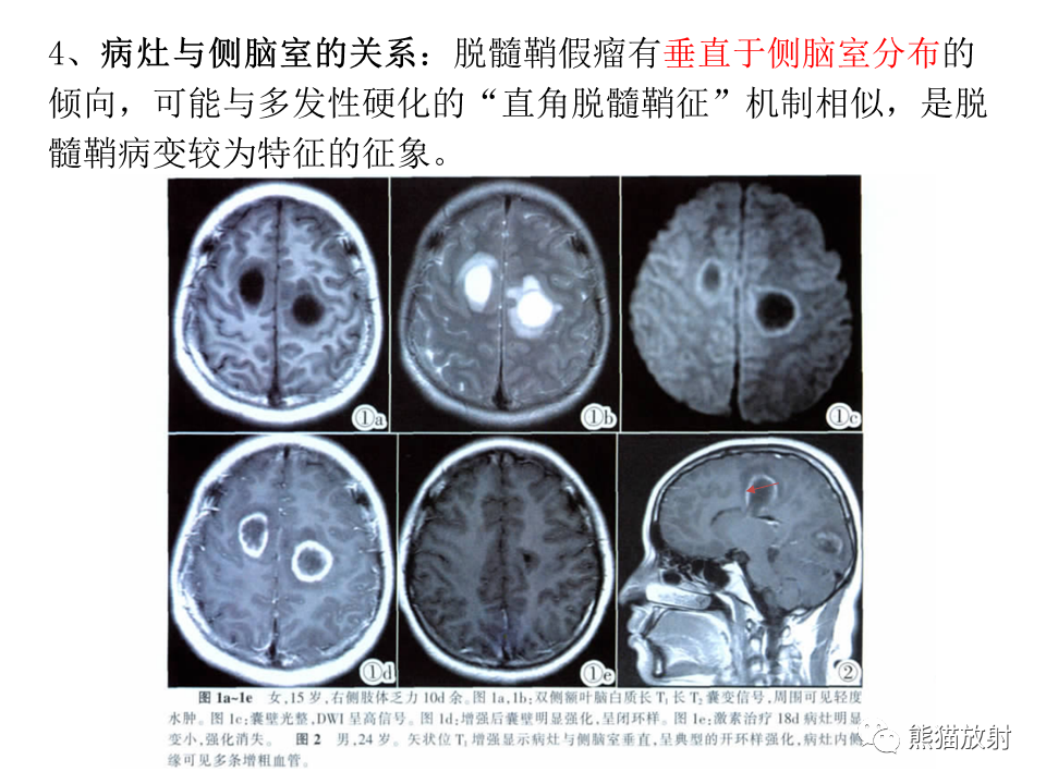 影像PPT - 【病例】脱髓鞘假瘤2例MR影像-38