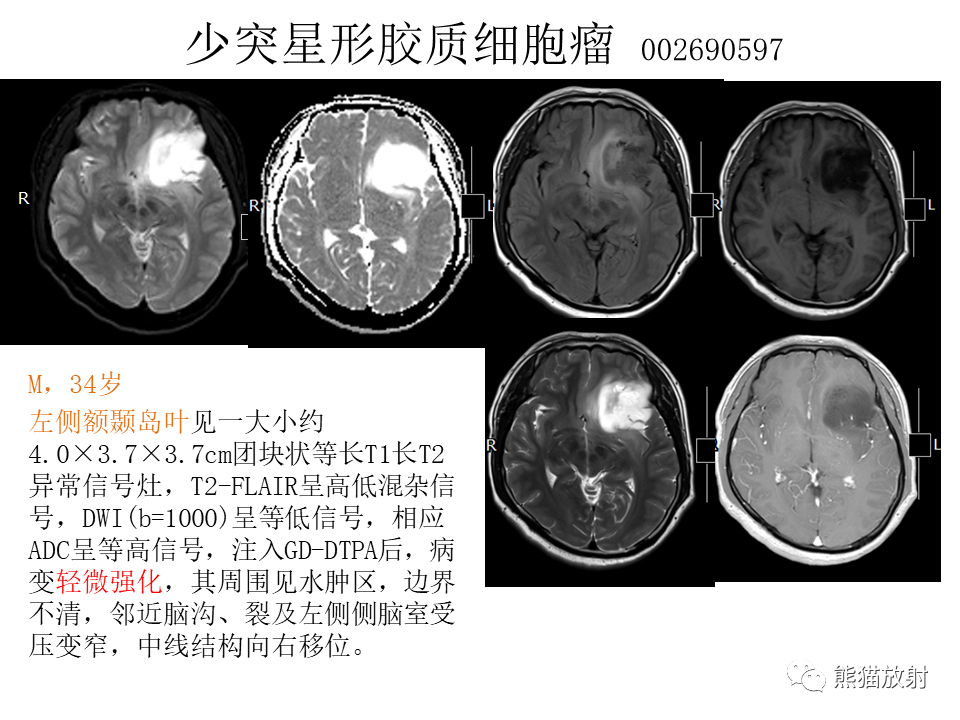 影像PPT - 【病例】脱髓鞘假瘤2例MR影像-40