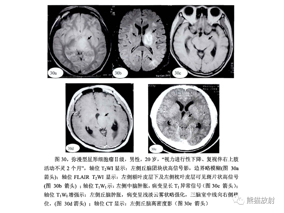 影像PPT - 【病例】脱髓鞘假瘤2例MR影像-41