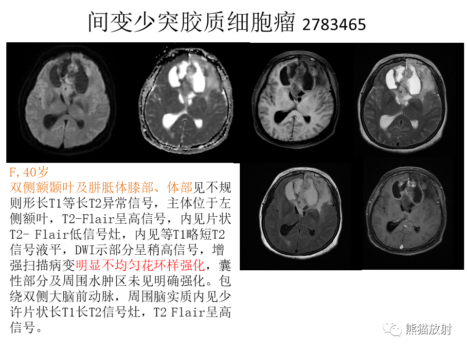 影像PPT - 【病例】脱髓鞘假瘤2例MR影像-42