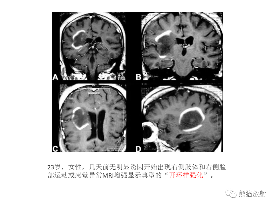 影像PPT - 【病例】脱髓鞘假瘤2例MR影像-37