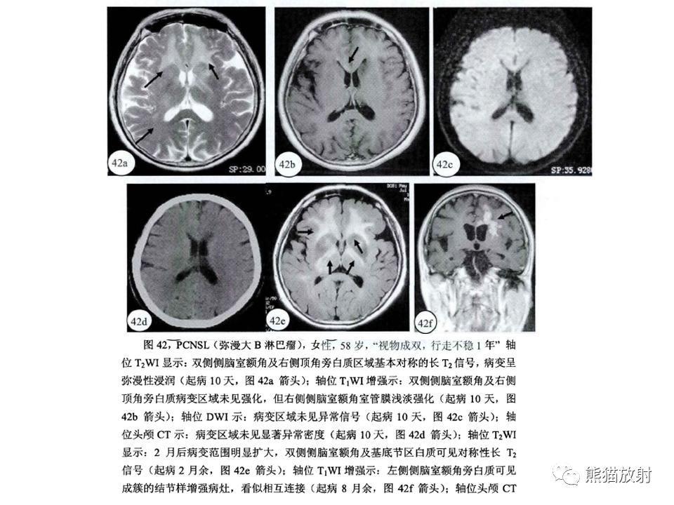 影像PPT - 【病例】脱髓鞘假瘤2例MR影像-45