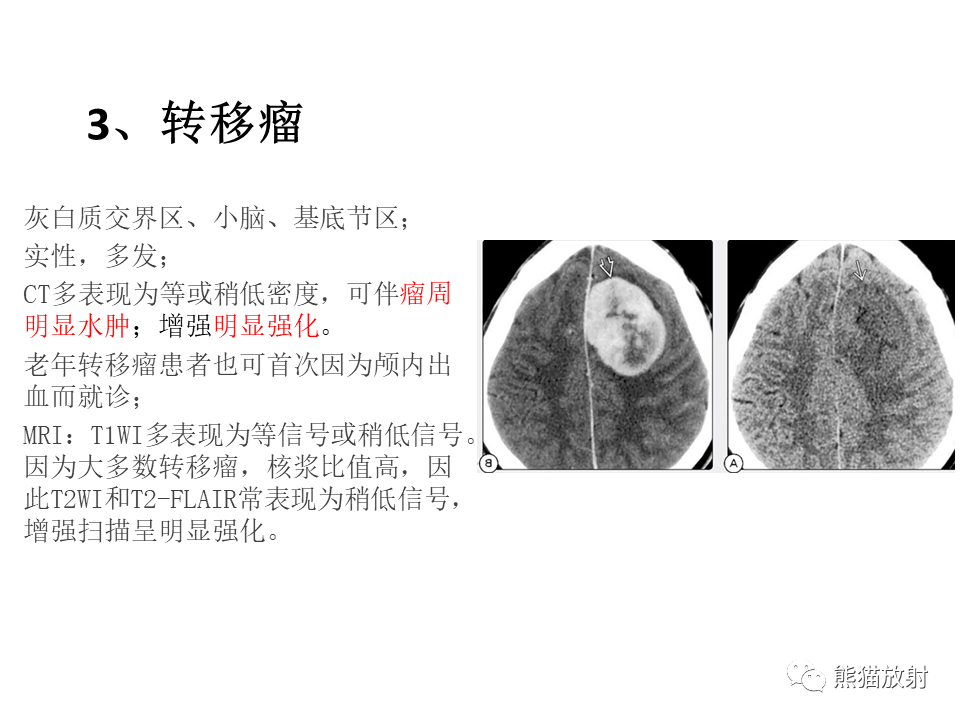 影像PPT - 【病例】脱髓鞘假瘤2例MR影像-46