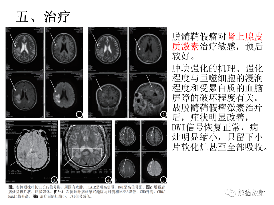 影像PPT - 【病例】脱髓鞘假瘤2例MR影像-49