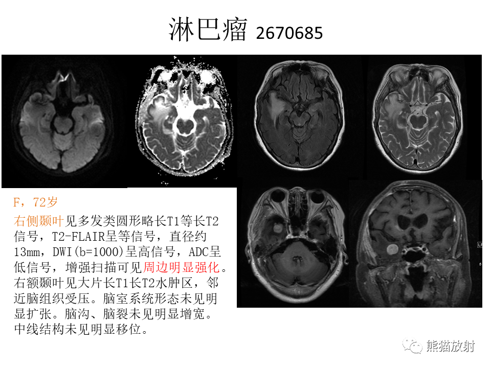 影像PPT - 【病例】脱髓鞘假瘤2例MR影像-44
