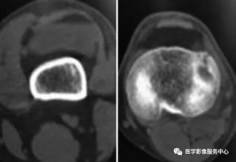 影像PPT - 只要看到这个影像学征象，肯定存在关节骨折-1