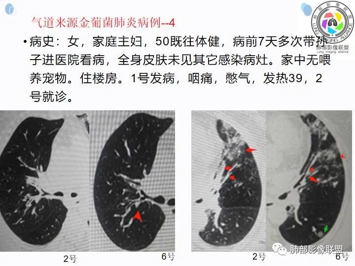 影像PPT - 【病例】金葡菌肺炎的是是非非-22 影像PPT - 【病例】金葡菌肺炎的是是非非-22