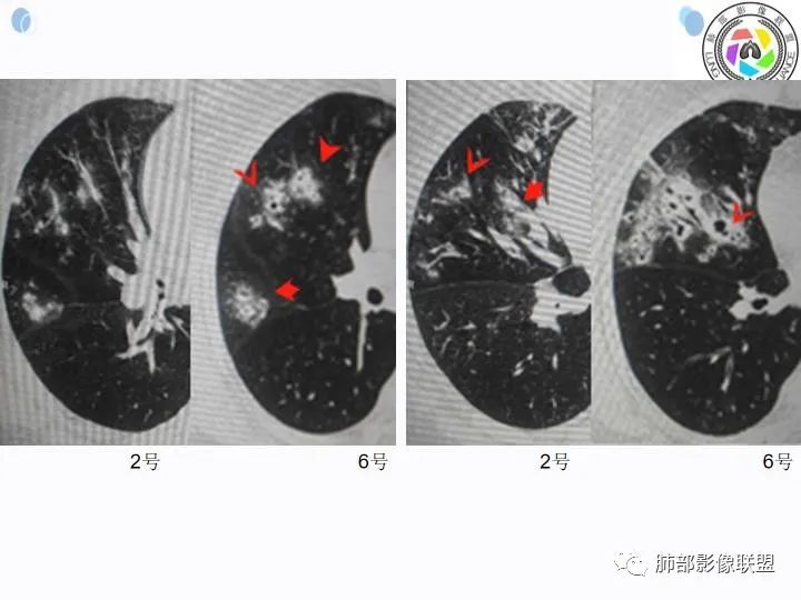 影像PPT - 【病例】金葡菌肺炎的是是非非-23 影像PPT - 【病例】金葡菌肺炎的是是非非-23