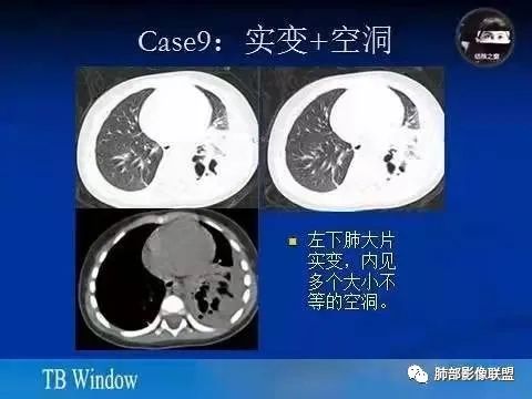 影像PPT - 【病例】金葡菌肺炎的是是非非-30 影像PPT - 【病例】金葡菌肺炎的是是非非-30