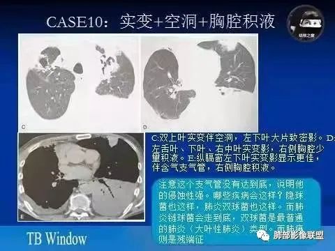 影像PPT - 【病例】金葡菌肺炎的是是非非-31 影像PPT - 【病例】金葡菌肺炎的是是非非-31