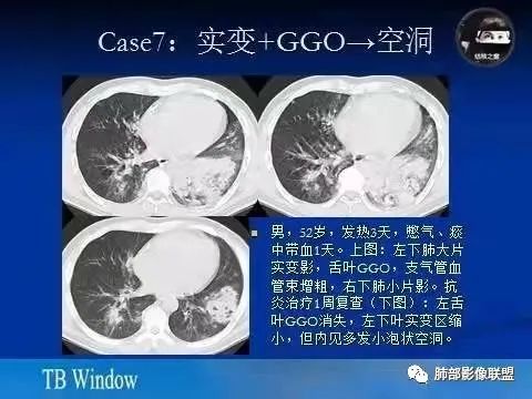 影像PPT - 【病例】金葡菌肺炎的是是非非-29 影像PPT - 【病例】金葡菌肺炎的是是非非-29