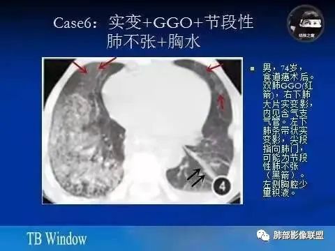 影像PPT - 【病例】金葡菌肺炎的是是非非-28 影像PPT - 【病例】金葡菌肺炎的是是非非-28