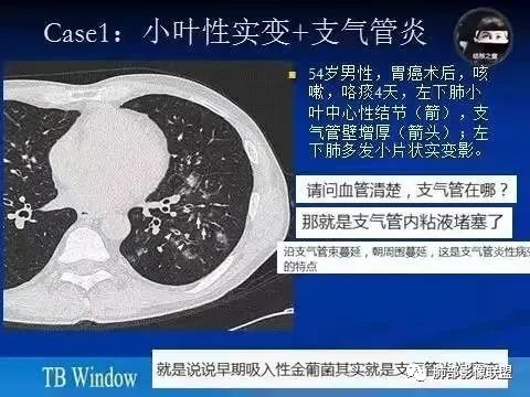 影像PPT - 【病例】金葡菌肺炎的是是非非-26 影像PPT - 【病例】金葡菌肺炎的是是非非-26