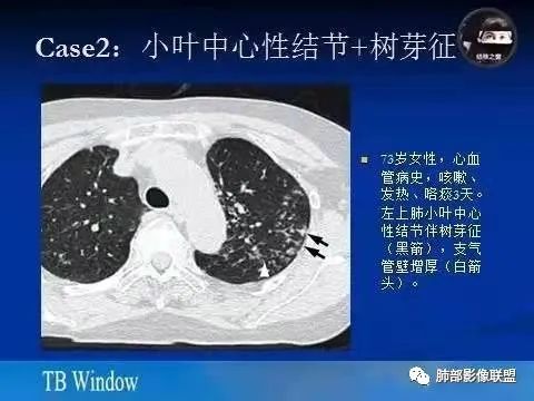 影像PPT - 【病例】金葡菌肺炎的是是非非-27 影像PPT - 【病例】金葡菌肺炎的是是非非-27
