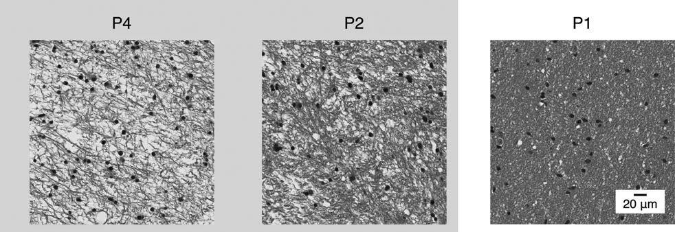 影像PPT - 局限性星形细胞瘤—放射科医生必须知道的基因组学-2 影像PPT - 局限性星形细胞瘤—放射科医生必须知道的基因组学-2
