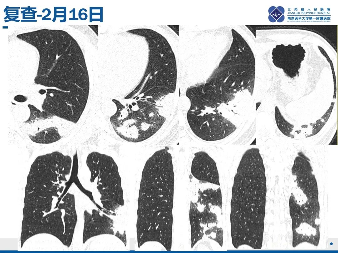 影像PPT - 【PPT】肺隐球菌病-8