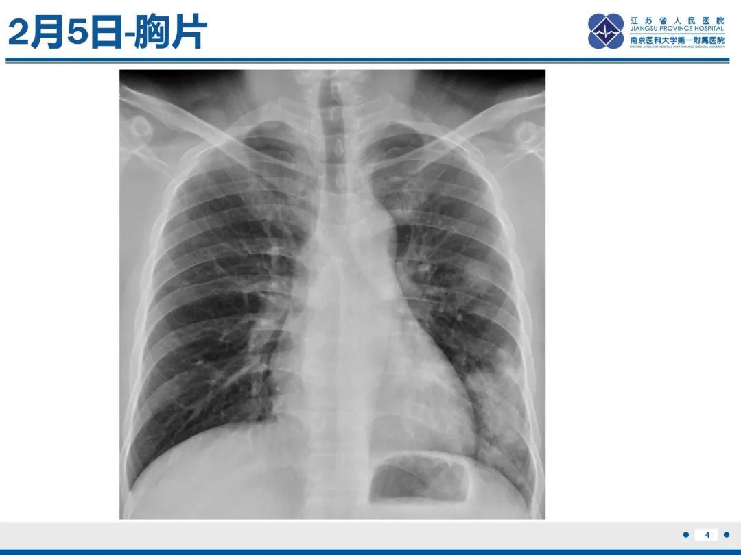 影像PPT - 【PPT】肺隐球菌病-5